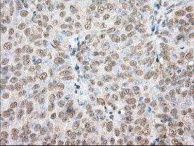 Immunohistochemistry-Paraffin: Phosphodiesterase 4A/PDE4A Antibody (1C8) [NBP2-02559] - Staining of paraffin-embedded Adenocarcinoma of Human ovary tissue using anti-PDE4A mouse monoclonal antibody.