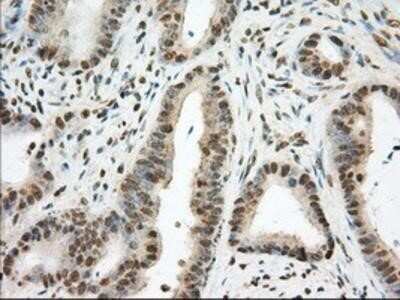 Immunohistochemistry: Phosphodiesterase 4A/PDE4A Antibody (OTI1C8) - Azide and BSA Free [NBP2-73376] - Staining of paraffin-embedded Adenocarcinoma of Human colon tissue using anti-PDE4A mouse monoclonal antibody.