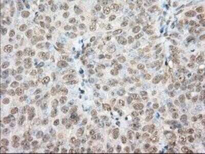 Immunohistochemistry: Phosphodiesterase 4A/PDE4A Antibody (OTI1C8) - Azide and BSA Free [NBP2-73376] - Staining of paraffin-embedded Adenocarcinoma of Human ovary tissue using anti-PDE4A mouse monoclonal antibody.