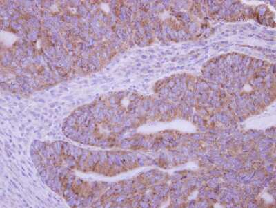 Immunohistochemistry-Paraffin: Phospholipase A2 XII Antibody [NBP2-19808] - Immunohistochemical analysis of paraffin-embedded Colon ca, using antibody at 1:500 dilution.