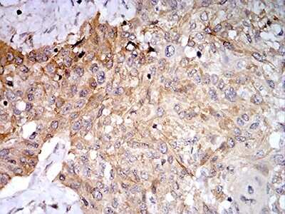 Immunohistochemistry: Phospholipase D2 Antibody (7E4D9) [NBP2-61784] - Analysis of paraffin-embedded esophageal cancer tissues using PLD2 mouse mAb with DAB staining.