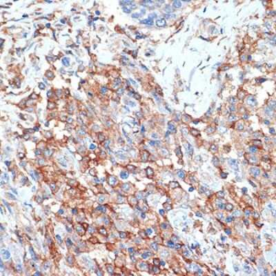 Immunohistochemistry-Paraffin: Phospholipid Scramblase 1/PLSCR1 Antibody (5U6G1) [NBP3-16183] - Immunohistochemistry of paraffin-embedded human breast cancer using Phospholipid Phospholipid Scramblase 1/PLSCR1 (PLSCR1) Rabbit mAb (NBP3-16183) at dilution of 1:100 (40x lens).Perform microwave antigen retrieval with 10 mM Tris/EDTA buffer pH 9.0 before commencing with IHC staining protocol.