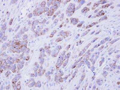 Immunohistochemistry-Paraffin: Phospholipid Scramblase 1/PLSCR1 Antibody [NBP1-32588] - MDAMB468 xenograft , using phospholipid scramblase 1 antibody at 1:500 dilution.Antigen Retrieval: Trilogy™ (EDTA based, pH 8.0) buffer, 15min.