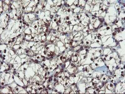 Immunohistochemistry: Phosphoribosyl Pyrophosphate Amidotransferase Antibody (1B11) [NBP2-45379] - Analysis of Carcinoma of Human kidney tissue. (Heat-induced epitope retrieval by 10mM citric buffer, pH6.0, 120C for 3min)