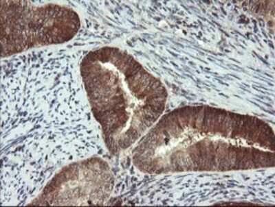 Immunohistochemistry: Phosphoribosyl Pyrophosphate Amidotransferase Antibody (1B11) [NBP2-45379] - Analysis of Adenocarcinoma of Human endometrium tissue. (Heat-induced epitope retrieval by 10mM citric buffer, pH6.0, 120C for 3min)