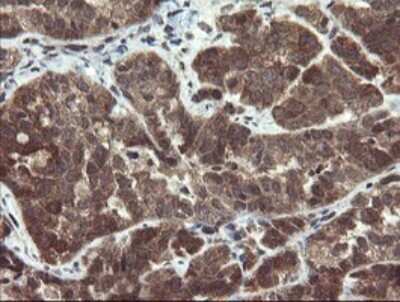 Immunohistochemistry: Phosphoribosyl Pyrophosphate Amidotransferase Antibody (1B11) [NBP2-45379] - Analysis of Adenocarcinoma of Human ovary tissue.(Heat-induced epitope retrieval by 10mM citric buffer, pH6.0, 120C for 3min)