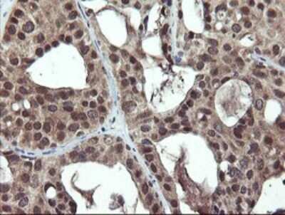 Immunohistochemistry: Phosphoribosyl Pyrophosphate Amidotransferase Antibody (1B11) [NBP2-45379] - Analysis of Adenocarcinoma of Human breast tissue. (Heat-induced epitope retrieval by 10mM citric buffer, pH6.0, 120C for 3min)