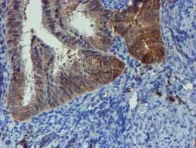 Immunohistochemistry: Phosphoribosyl Pyrophosphate Amidotransferase Antibody (OTI1B8) - Azide and BSA Free [NBP2-73394] - Staining of paraffin-embedded Adenocarcinoma of Human endometrium tissue using anti-Phosphoribosyl Pyrophosphate Amidotransferase mouse monoclonal antibody.