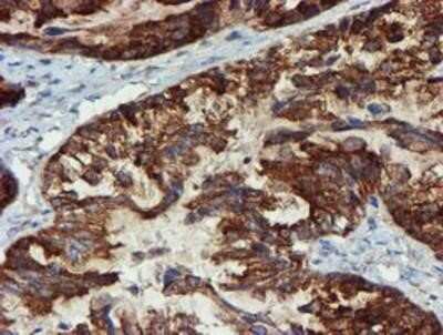Immunohistochemistry: Phosphoribosyl Pyrophosphate Amidotransferase Antibody (OTI1B8) - Azide and BSA Free [NBP2-73394] - Staining of paraffin-embedded Adenocarcinoma of Human ovary tissue using anti-Phosphoribosyl Pyrophosphate Amidotransferase mouse monoclonal antibody.