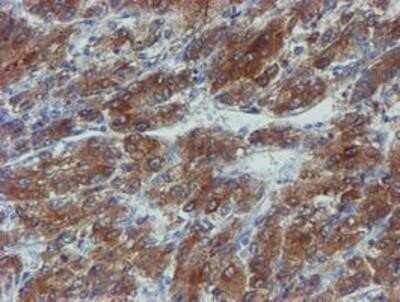 Immunohistochemistry: Phosphoribosyl Pyrophosphate Amidotransferase Antibody (OTI1B8) - Azide and BSA Free [NBP2-73394] - Staining of paraffin-embedded Carcinoma of Human liver tissue using anti-Phosphoribosyl Pyrophosphate Amidotransferase mouse monoclonal antibody.