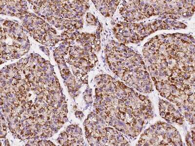 Immunohistochemistry-Paraffin: Pipecolic acid oxidase Antibody [NBP2-99598] - Immunochemical staining of human Pipecolic acid oxidase in human hepatoma with rabbit polyclonal antibody at 1:1000 dilution, formalin-fixed paraffin embedded sections.