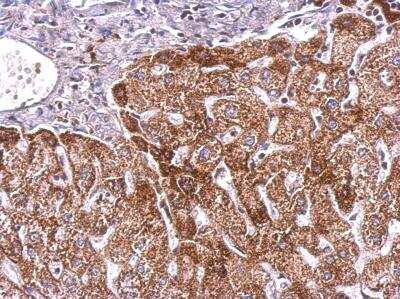 Immunohistochemistry-Paraffin: PlGF Antibody [NBP1-32169] - Paraffin-embedded hepatoma; antibody dilution 1:200.