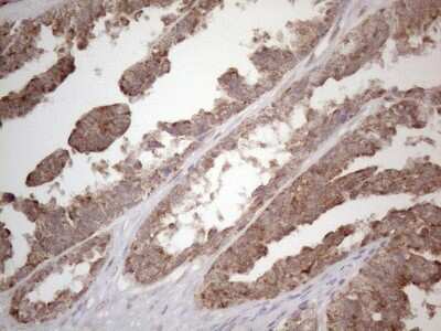 Immunohistochemistry: Podocalyxin Antibody (2C6) [NBP2-45362] - Analysis of Adenocarcinoma of Human ovary tissue. (Heat-induced epitope retrieval by 1mM EDTA in 10mM Tris buffer (pH8.5) at 120C for 3 min)