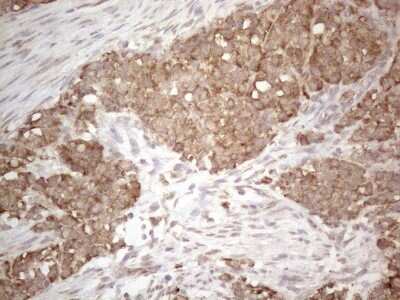 Immunohistochemistry: Podocalyxin Antibody (2C6) [NBP2-45362] - Analysis of Adenocarcinoma of Human endometrium tissue.(Heat-induced epitope retrieval by 1mM EDTA in 10mM Tris buffer (pH8.5) at 120C for 3 min)