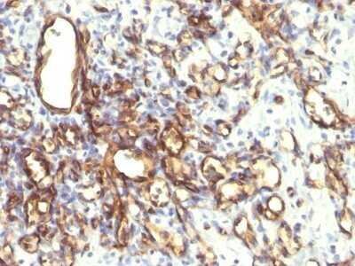 Immunohistochemistry-Paraffin: Podocalyxin Like Antibody (2A4) - Azide and BSA Free [NBP2-47750] - Human Angiosarcoma stained with Podocalyxin Monoclonal Antibody (2A4).