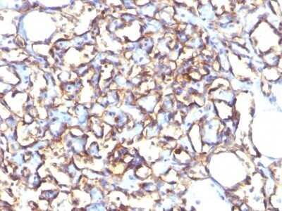 Immunohistochemistry-Paraffin: Podocalyxin Like Antibody (3D3) - Azide and BSA Free [NBP2-33108] - Formalin-fixed, paraffin-embedded human Angiosarcoma stained with Podocalyxin Like Antibody (3D3).