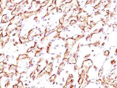 Immunohistochemistry-Paraffin: Podocalyxin Like Antibody (3D3) - Azide and BSA Free [NBP2-33108] - Formalin-paraffin angiosarcoma stained with Podocalyxin Ab (3D3).