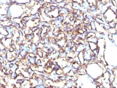Immunohistochemistry-Paraffin: Podocalyxin Like Antibody (3D3) - IHC-Prediluted [NBP2-45167] - Formalin-fixed, paraffin-embedded human Angiosarcoma stained with Podocalyxin Like Antibody (3D3).
