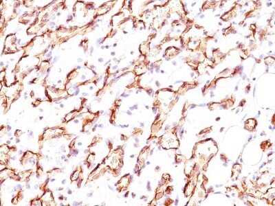 Immunohistochemistry-Paraffin: Podocalyxin Like Antibody (3D3) - IHC-Prediluted [NBP2-45167] - Formalin-paraffin angiosarcoma stained with Podocalyxin Ab (3D3).
