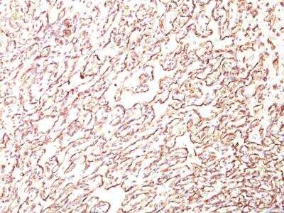 Immunohistochemistry-Paraffin: Podocalyxin Like Antibody (4F10) - IHC-Prediluted [NBP2-48343] - Formalin-fixed, paraffin-embedded human Angiosarcoma stained with Podocalyxin Monoclonal Antibody (4F10).