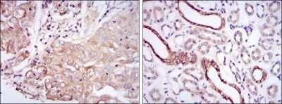 Immunohistochemistry: Podocalyxin Like Antibody (5F5) [NBP2-37605] - Immunohistochemical analysis of paraffin-embedded lung cancer tissues (left) and kidney tissues (right) using PODXL mouse mAb with DAB staining.