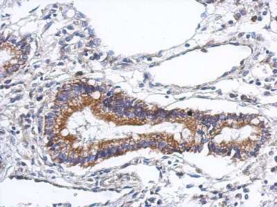 Immunohistochemistry-Paraffin: Podocan Antibody [NBP2-19881] - Human gastric cancer, using PODN antibody at 1:500 dilution. Antigen Retrieval: Trilogy™ (EDTA based, pH 8.0) buffer, 15min.