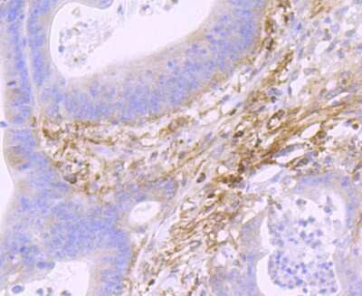 Immunohistochemistry-Paraffin: Podoplanin Antibody (JM31-21) [NBP2-67070] - Analysis of paraffin-embedded human colon cancer tissue using anti-Podoplanin antibody. Counter stained with hematoxylin.