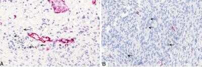 Immunohistochemistry: Podoplanin Antibody (LF3/B7/D5B27) - Azide and BSA Free [NBP2-80915] - Non-neoplastic histopathological findings in the abdominal cavity. A: High-power view of anti-podoplanin immunohistochemistry showing single MWCNT A (high dose) nanotubes in the tissue (arrows). B: High-power view of anti-podoplanin immunohistochemistry