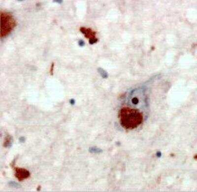 Immunohistochemistry-Paraffin: Poly-Ubiquitin Antibody (HWA4C4) - K63 Linkage [NBP2-36523] - Poly-Ubiquitin K63 Linkage Antibody (HWA4C4) [NBP2-36523] - Sections of hippocampus from human Alzheimers disease brain stained at 1:100 dilution with biotinylated secondary antibody and DAB detection.