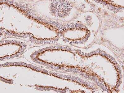 Immunohistochemistry-Paraffin: Polypeptide GalNac Transferase 7/GALNT7 Antibody [NBP1-32491] - Paraffin-embedded Endometrial CA, using antibody at 1:100 dilution.