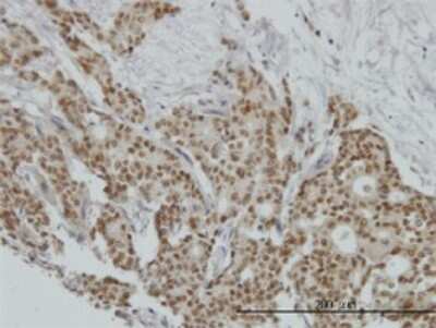 Immunohistochemistry-Paraffin: Progesterone R/NR3C3 Antibody (3E11) [H00005241-M01] - Analysis of monoclonal antibody to PGR on formalin-fixed paraffin-embedded human breast cancer. Antibody concentration 3 ug/ml.