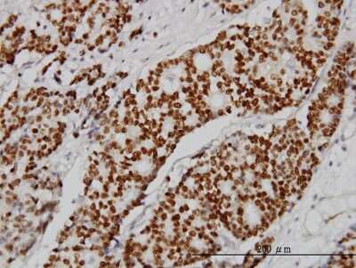 Immunohistochemistry-Paraffin: Progesterone R/NR3C3 Antibody (5D10) [H00005241-M07] - Analysis of monoclonal antibody to PGR on formalin-fixed paraffin-embedded human breast cancer. Antibody concentration 3 ug/ml