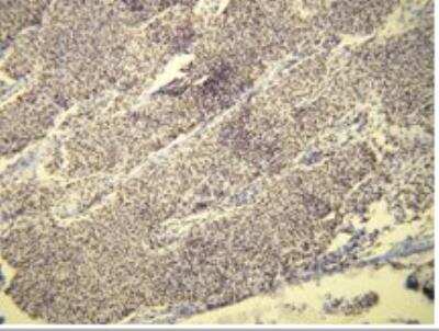 Immunohistochemistry-Paraffin: Progesterone R/NR3C3 Antibody (A21-W) [NBP1-79078] - Diffuse nuclear progesterone receptor (PR) expression in meningothelial meningioma. Formalin fixed, paraffin embedded human tissue (4 um section) stained with anti-PR.