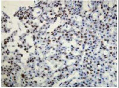Immunohistochemistry-Paraffin: Progesterone R/NR3C3 Antibody (A21-W) [NBP1-79078] - Progesterone receptor (PR) expression in the carcinoma of the breast. Formalin fixed, paraffin embedded human tissue (4 um section) stained with anti-PR.