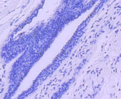 Immunohistochemistry-Paraffin: Progesterone R/NR3C3 Antibody (JF0549) [NBP2-67079] - Analysis of paraffin-embedded human breast carcinoma tissue using anti-Progesterone Receptor antibody. Counter stained with hematoxylin.