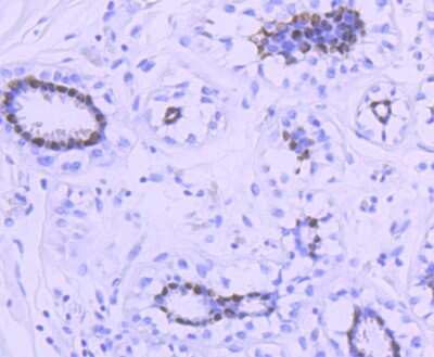 Immunohistochemistry-Paraffin: Progesterone R/NR3C3 Antibody (JF0549) [NBP2-67079] - Analysis of paraffin-embedded human breast tissue using anti-Progesterone Receptor antibody. Counter stained with hematoxylin.