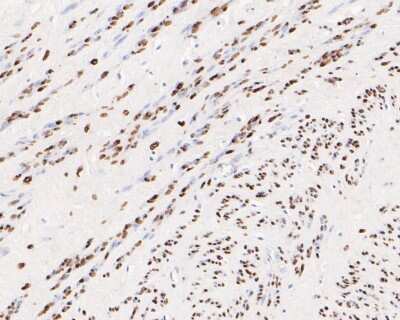 Immunohistochemistry-Paraffin: Progesterone R/NR3C3 Antibody (JF0549) [NBP2-67079] - Immunohistochemical analysis of paraffin-embedded human cervix tissue using anti-Progesterone R/NR3C3 antibody. The section was pre-treated using heat mediated antigen retrieval with sodium citrate buffer (pH 6.0) for 20 minutes. The tissues were blocked in 5% BSA for 30 minutes at room temperature, washed with ddH2O and PBS, and then probed with the primary antibody (1/50) for 30 minutes at room temperature. The detection was performed using an HRP conjugated compact polymer system. DAB was used as the chromogen. Tissues were counterstained with hematoxylin and mounted with DPX.