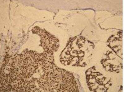 Immunohistochemistry-Paraffin: Progesterone R/NR3C3 Antibody (P21-S) [NBP1-79004] - Diffuse and strong progesterone receptor expression in mucinous breast carcinoma, stained with anti-PR monospecific antibody. Formalin fixed, paraffin embedded human tissue (4 um section) stained.