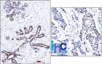 Immunohistochemistry-Paraffin: Progesterone R/NR3C3 Antibody (PR501) - Azide and BSA Free [NBP2-33369] - Formalin-paraffin normal human breast (left) and invasive ductal carcinoma (right) stained with progesterone receptor Ab (PR501).
