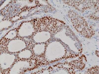 Immunohistochemistry: Progesterone R/NR3C3 Antibody (RM357) [NBP2-77437] - Immunohistochemical staining of formalin fixed and paraffin embedded human breast cancer tissue section using NBP2-77437.