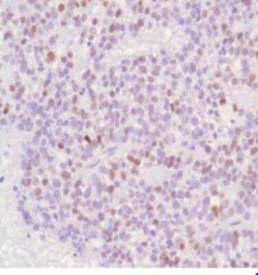 Immunohistochemistry-Paraffin: Progesterone R/NR3C3 Antibody (SP42) [NBP1-49806] - Human Ovarian Adenocarcinoma 