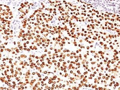 Immunohistochemistry-Paraffin: Progesterone R/NR3C3 Antibody (SPM566) - IHC-Prediluted [NBP2-44917] - Formalin-paraffin normal human breast carcinoma stained with Progesterone Receptor MAb (SPM566).