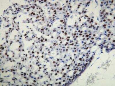 Immunohistochemistry-Paraffin: Progesterone R/NR3C3 Antibody (X22-C) [NBP1-79077] - Progesterone receptor (PR) expression in the ductal carcinoma of the breast. Formalin fixed, paraffin embedded human tissues (4 um sections) stained with anti - PR monospecific clonal antibody