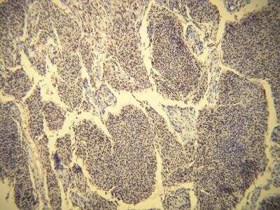 Immunohistochemistry-Paraffin: Progesterone R/NR3C3 Antibody (X22-C) [NBP1-79077] - Diffuse nuclear progesterone receptor (PR) expression in meningothelial meningioma. Formalin fixed, paraffin embedded human tissues (4 um sections) stained with anti - PR monospecific clonal antibody 