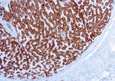 Immunohistochemistry-Paraffin: Prohibitin Antibody (II-14-10) [NB600-1292] - Formalin fixed paraffin embedded liver hepato cellular carcinoma stained with Prohibitin antibody (NB600-1292).
