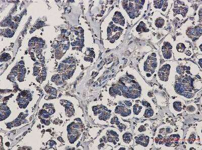 Immunohistochemistry-Paraffin: Prohibitin Antibody (S07-2G1) [NBP3-19909] - Immunohistochemistry of Prohibitin in paraffin-embedded Human Cholangiocarcinoma using NBP3-19909 at dilution 1/50