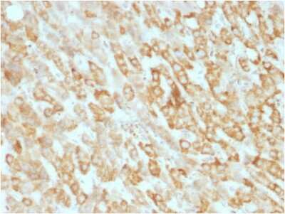 Immunohistochemistry-Paraffin: Prohibitin Antibody (SPM311) [NBP3-07832] - Formalin-fixed, paraffin-embedded human Hepatic Carcinoma stained with Prohibitin Mouse Monoclonal Antibody (SPM311).