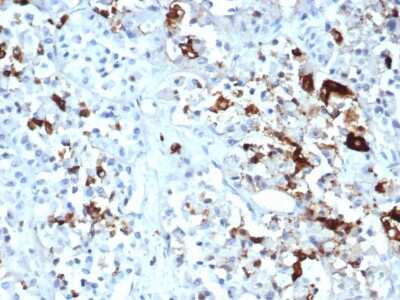 Immunohistochemistry-Paraffin: Prolactin Antibody (PRL/4908R) - Azide and BSA Free [NBP3-08249] - Formalin-fixed, paraffin-embedded human pituitary carcinoma stained with Prolactin Recombinant Rabbit Monoclonal Antibody (PRL/4908R).