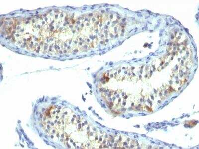 Immunohistochemistry-Paraffin: Prolactin R Antibody (B6.2) [NBP2-32991] - Formalin-fixed, paraffin-embedded human Testicular Carcinoma stained with Prolactin Receptor Monoclonal Antibody (B6.2).