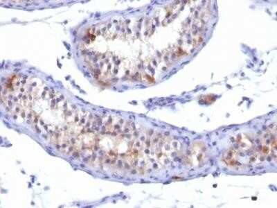 Immunohistochemistry-Paraffin: Prolactin R Antibody (PRLR/742) [NBP2-32899] - Formalin-fixed, paraffin-embedded human Testicular Carcinoma stained with Prolactin Receptor Monoclonal Antibody (PRLR742).